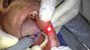 Image result for aphthous ulcers