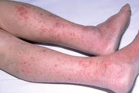 Small spots develop at first and may occur in groups note: Meningitis Symptoms Nhs