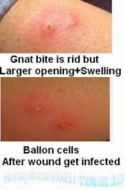 How To Get Rid Of Gnat Bites Stop Itching Allergy And