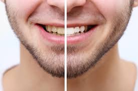 natural teeth whitening dr andrew