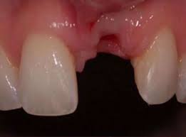 wisdom tooth extraction the painless