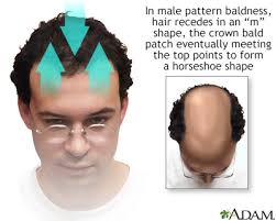 male pattern baldness information