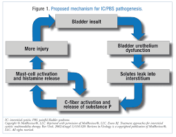 intersial cysis and chronic pain