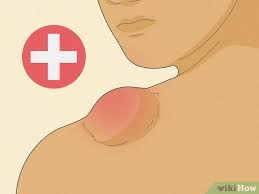 3 ways to treat lipomas naturally wikihow