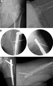 intertrochanteric femur fracture