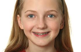 caring for braces mol orthodontics