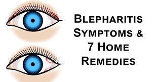 blepharitis symptoms 7 home remes