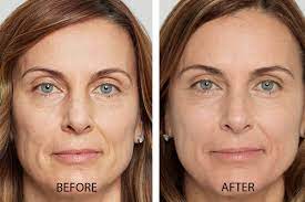 sculptra treatments in beverly hills