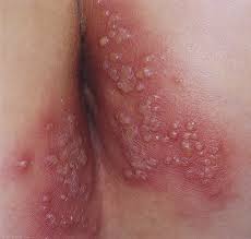 These present approximately 6 days after infection. Cutaneous Herpes Anesthesia Key