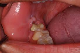 wisdom teeth anacapa surgery