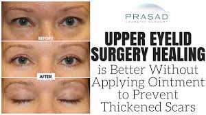 upper eyelid surgery healing