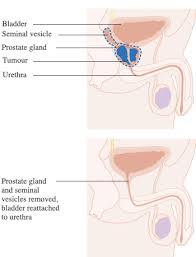 ual dysfunction after prostate