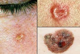 Be growths that have raised edges and a lower center plus abnormal blood vessels that spread from the growth like the spokes of a wheel. Skin Cancer Picture Image On Medicinenet Com