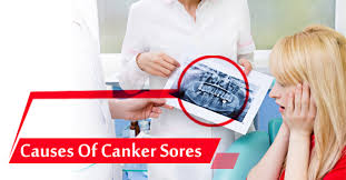 the top 10 causes of canker sores