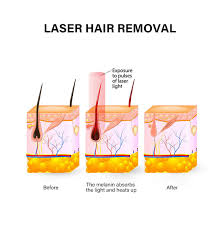 808 diode laser hair removal instrument