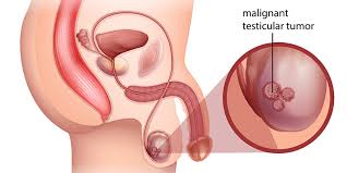 testicular cancer metromale clinic