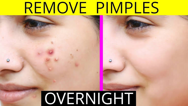 pimples 