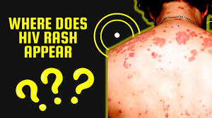 where does hiv rash appear skin