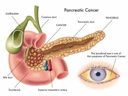 Symptoms of pancreatic cancer may include jaundice, abdominal and/or back pain, new onset diabetes it certainly wouldn't be surprising to become depressed after learning you have pancreatic cancer an enlarged (swollen) lymph node that can be felt just above the collarbone on the left side. Pancreatic Cancer Symptoms And Causes