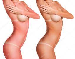 Sunburn female naked body Stock Photo by ©kotin 116926258