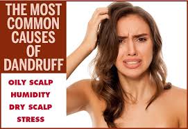 main causes of dandruff how to avoid