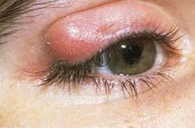 علاج الكيس الدهني بالعين