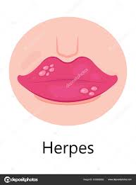 herpes lips vector simplex virus