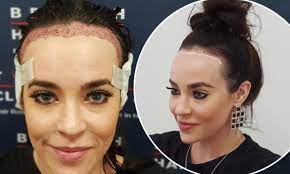 Mar 05, 2020 · female hair transplant ; Stephanie Davis Reveals She S Had A Hair Transplant After Years Of Bullying Over Her High Forehead Daily Mail Online