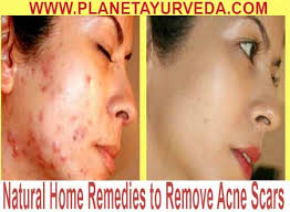 home remes to remove acne scars