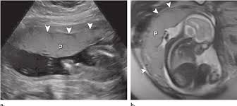 normal placenta a us image shows a