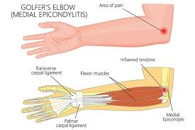 get relief from golfer s elbow sforzo