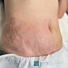stretch marks scar removal fotona