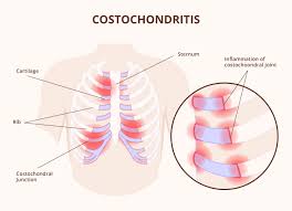 costochondritis symptoms diagnosis