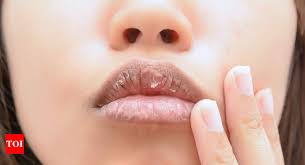 how to treat dry and chapped lips using