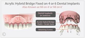 Check spelling or type a new query. Packages Dental Implant Group