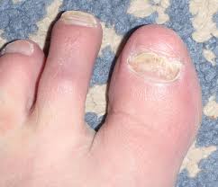 toe nail fungus barefoot running blood