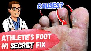 best 9 athlete s foot fungus remes