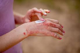 how hand eczema is treated