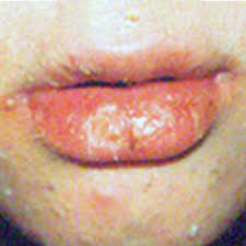 accutane lips accutane patients dr