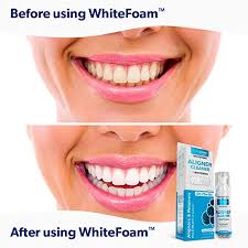 How to clean invisalign trays. Whitefoam On The Go Clear Retainer Cleaner For Invisalign Dentures Clearcorrect Essix Vivera Hawley Trays Aligners Cleans Kills Bacteria Whitens Teeth Fights Bad Breath 50ml 1 Pack Pricepulse