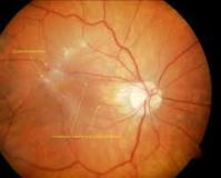 Image result for icd 10 code for erm left eye