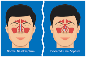 a deviated septum can affect your daily