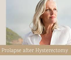prolapse after hysterectomy