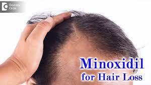 use minoxidil solution for hair loss