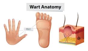 10 easy wart removal home remes dr