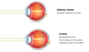 A Comprehensive Guide To Myopia Short Sightedness Laser