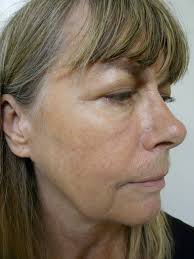 However, many people do not want to have jowls. Video Non Surgical Jowl Lift In Los Angeles By Dr Umar