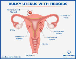 About stages signs causes risk factors treatment diet natural remedies. Bulky Uterus It S Symptoms Causes And Treatment Medicover Fertility