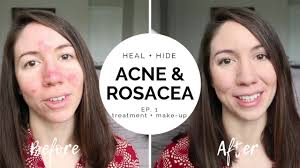 heal hide severe acne rosacea ep
