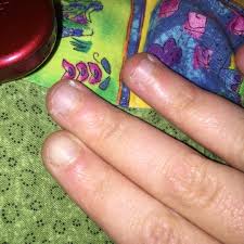 tiny brown spots nail disorders